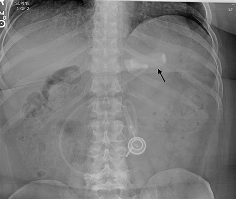 Cureus | Laparoscopic Adjustable Gastric Band Slippage Presenting as Chest Pain