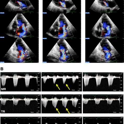 Factors affecting stress echocardiography interpretation and accuracy ...