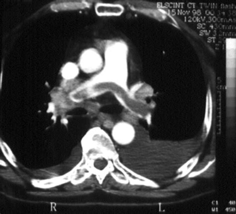 Saddle Pulmonary Embolism