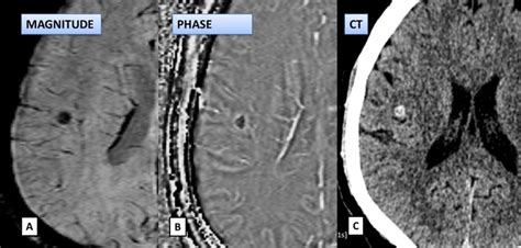 Calcified granuloma appearing dark on both magnitude and phase image in... | Download Scientific ...