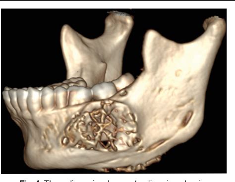 Figure 3 from Odontogenic Myxoma of the Mandible : A Rare Case Report | Semantic Scholar