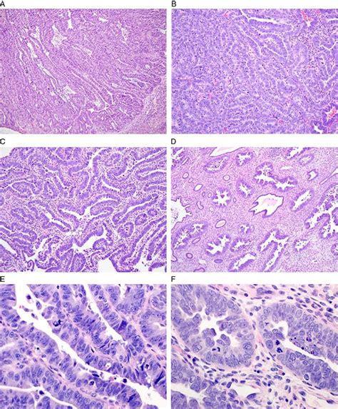 The glandular pattern of endometrial serous carcinoma may mimic the... | Download Scientific Diagram