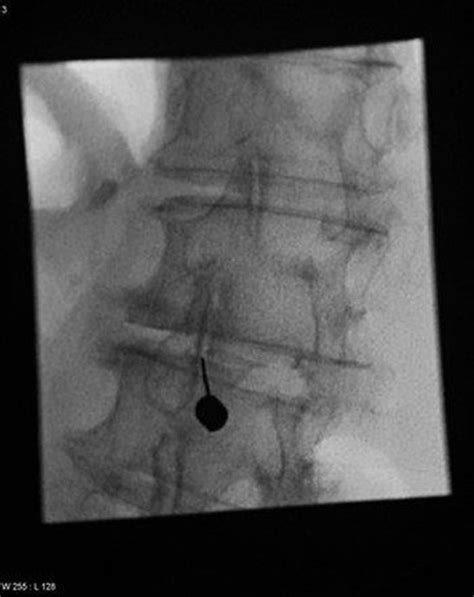 Facet joint injections - Specialist Pain Clinic