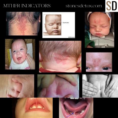 MTHFR Deficiency Symptoms | Revealed