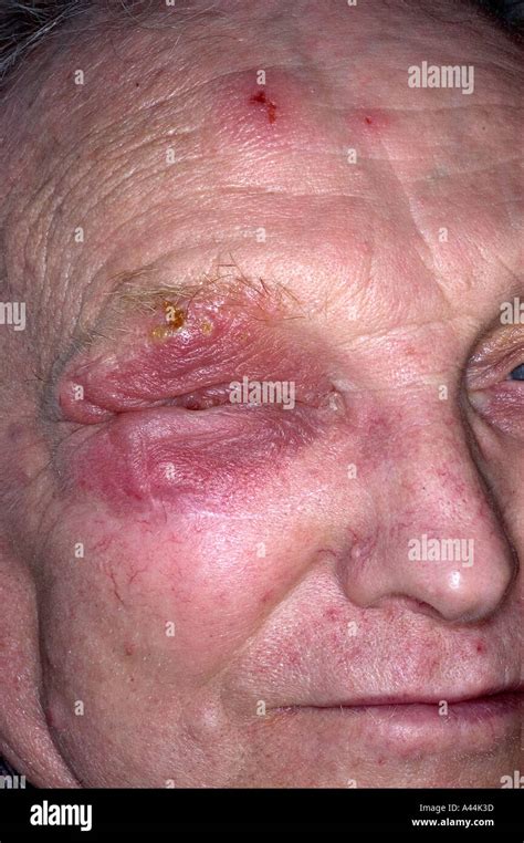 herpes zoster shingles rash on the face Stock Photo - Alamy