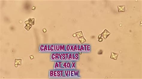 Calcium Oxalate crystals(+++) in urine routine microscopy.Ca.Oxlate 40X ...