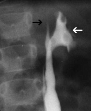 Retrograde Pyelography: Background, Indications, Contraindications