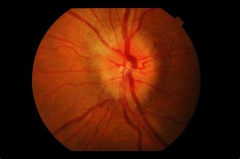 Learn More On What Are The Causes Of Optic Nerve Damage