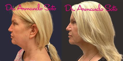 Nonsurgical Neck Lift Before and After Pictures Case 76271 | Orlando ...