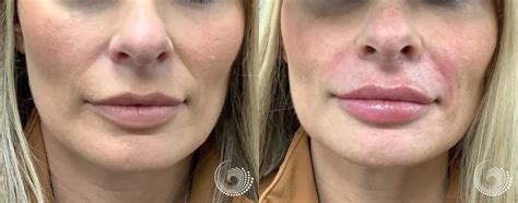 Filler Treatment, before and after – lip augmentation, smile lines