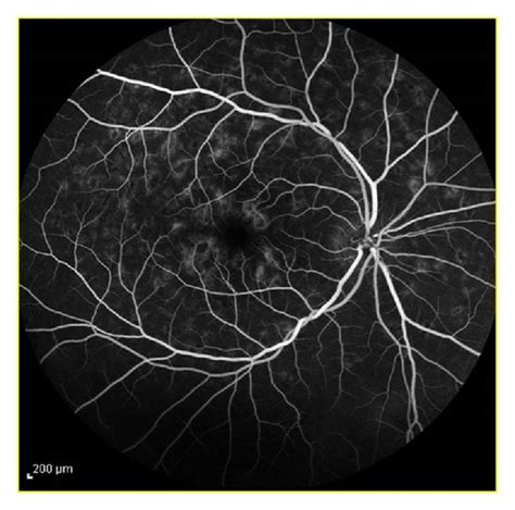 Color photograph shows macular atrophy and retinal flecks in a... | Download Scientific Diagram