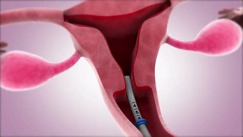 Insertion of an intrauterine device into the uterus. - Stock Video Footage - Dissolve