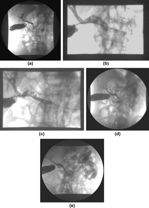 Percutaneous cholecystostomy in critically ill patients with acute cholecystitis: Complications ...