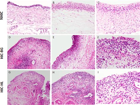 Representative histology of non-Hunner-type interstitial cystitis ...