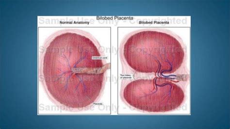 Antepartum Hemorrhage