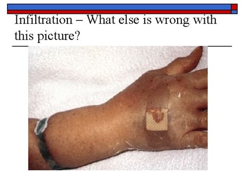 Complications of Intravenous Therapy Principles of IV Therapy