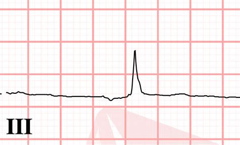 J point ECG