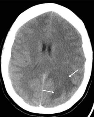 Brain Abscess Ct Scan