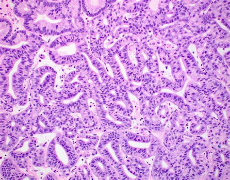 Pathology Outlines - Oxyntic gland adenoma