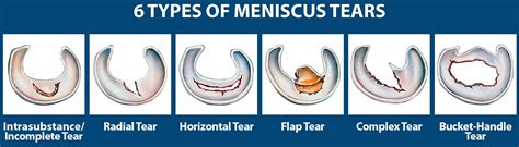 Meniscus tear knee symptoms, signs, diagnosis, treatment and recovery