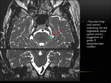 Figure 14 from Imaging in neurovascular conflict of the trigeminal nerve with grading of its ...