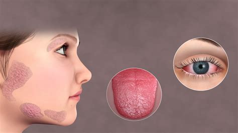 Sjogren's Syndrome - WikiMSK