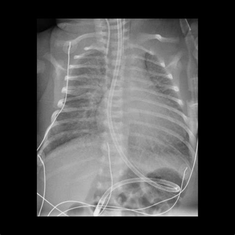 Pediatric Myocarditis | Pediatric Radiology Reference Article | Pediatric Imaging | @pedsimaging