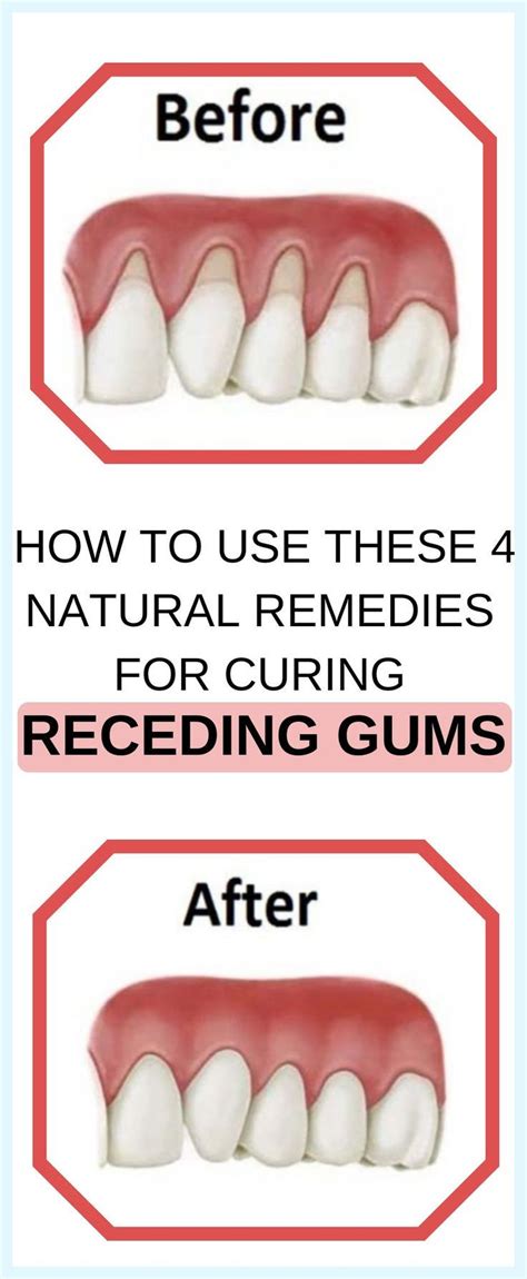 7 Natural Ways To Treat Receding Gums | Receding gums, Natural remedies ...