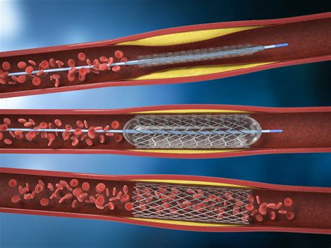 Penumbra Catheter Class Action Lawsuit | Catheter Injury Lawyer