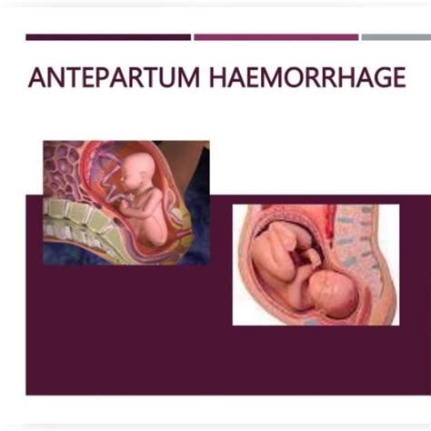 Let’s talk about Antepartum Haemorrhage (Part-2) – Platform | CME