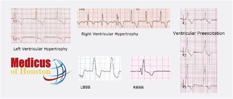 Repolarization abnormalities | ECG Guru - Instructor Resources