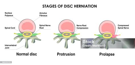 Difference Between Bulging Disc And Herniated Disc Stages Of Spinal ...