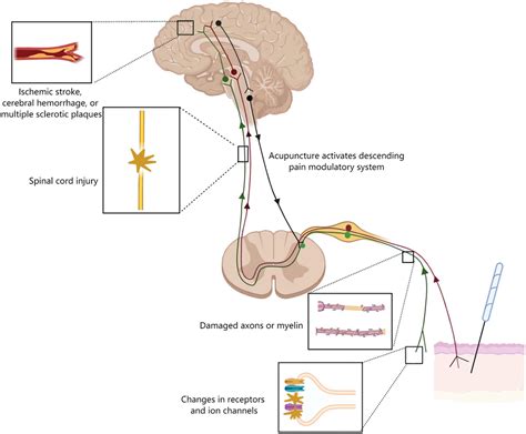 Frontiers | Potential mechanisms of acupuncture for neuropathic pain ...