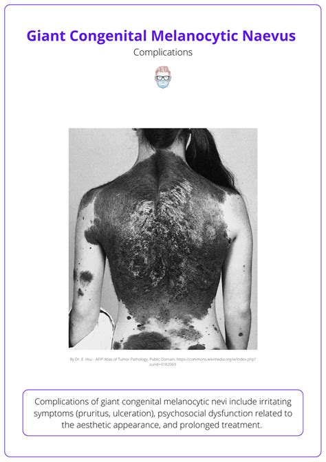 Congenital Melanocytic Nevus