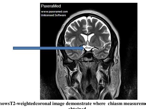 Figure 2 from Assessment of Optic Chiasm Measurements in Abnormal MRI ...