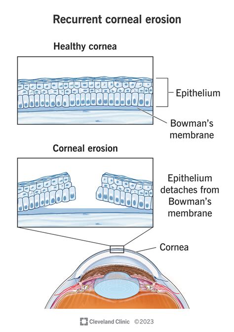 Recurrent Corneal Erosion: Symptoms & Treatment