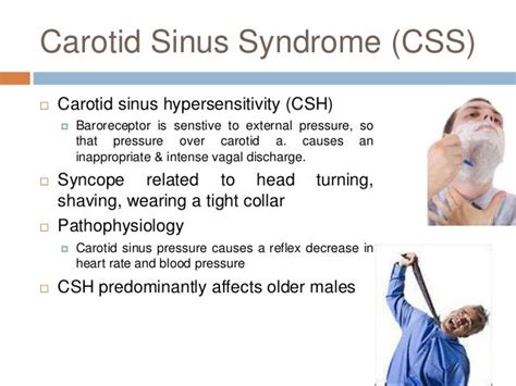 Carotid Sinus Syndrome Symptoms - Captions Blog