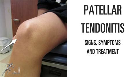 Patellar Tendinitis - Carolina Regional Orthopedics