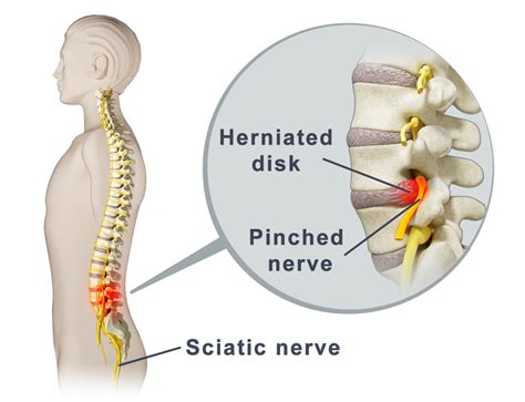 What is a Pinched Nerve? Cause & Symptoms of a Pinched Nerve