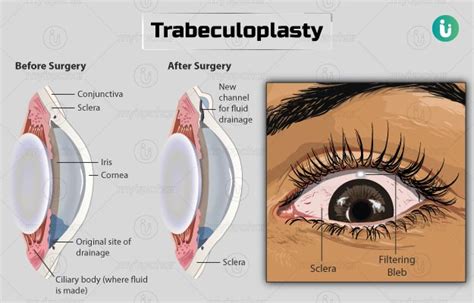 Trabeculoplasty: Procedure, Purpose, Results, Cost, Price