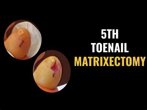 5th Toenail Matrixectomy - YouTube