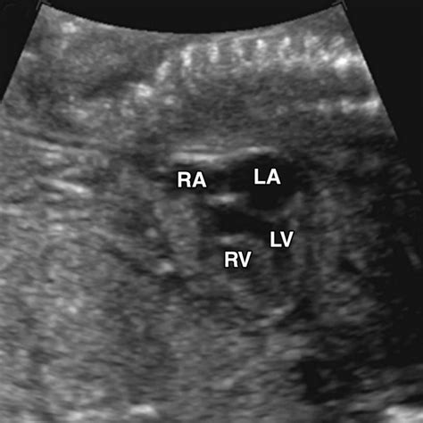 Hypoplastic right heart syndrome causes, symptoms, diagnosis, treatment & prognosis