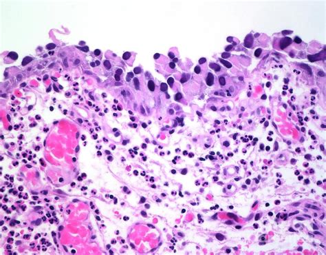 Urothelial Carcinoma-in-situ Photograph by Webpathology/science Photo Library