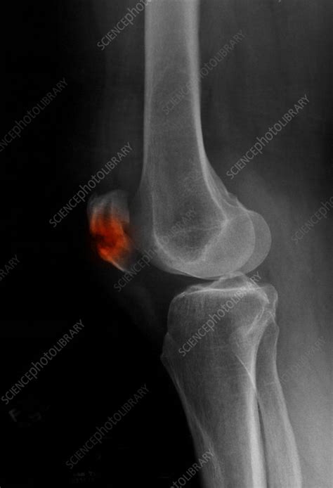 Patella Fracture, X-ray - Stock Image - C027/2711 - Science Photo Library