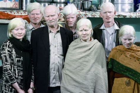 The Largest Albino Family in the World | Amazing & Funny