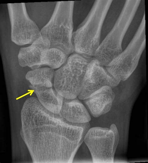 Scaphoid fracture – Radiology Cases