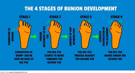 HAV (Hallux abducto valgus deformity) or ‘bunions’ - Harding Podiatry