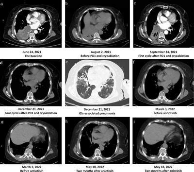 Frontiers | Significant response of pulmonary sarcomatoid carcinoma ...