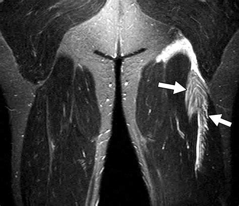 Mri Hamstring Tear Google Search Hamstrings Torn