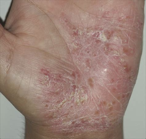 Leflunomide in the Treatment of Palmoplantar Pustulosis | Dermatology | JAMA Dermatology | JAMA ...